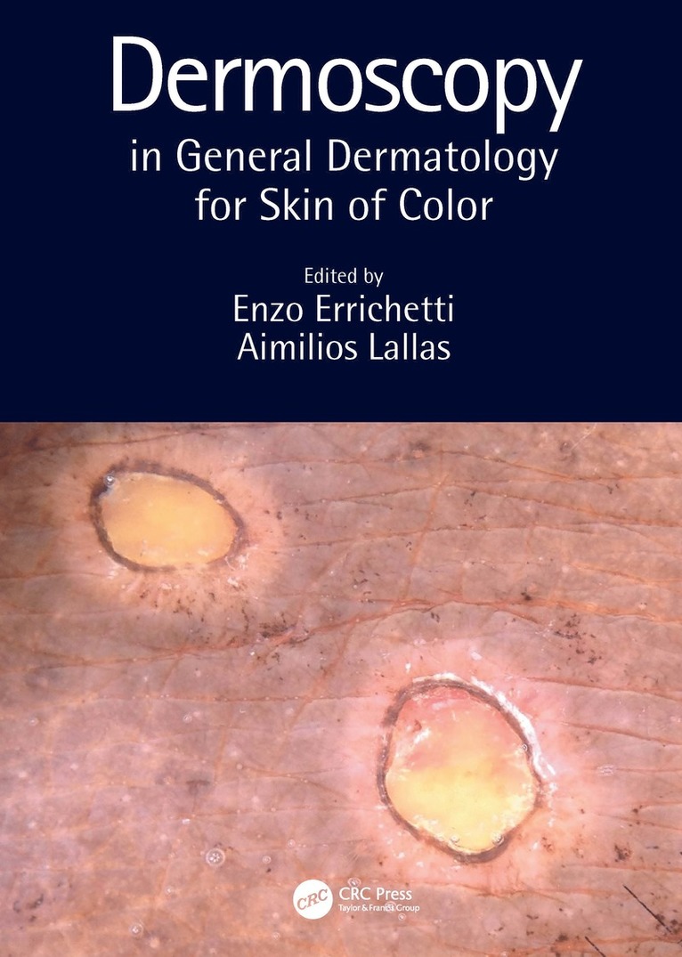 Dermoscopy in General Dermatology for Skin of Color 1