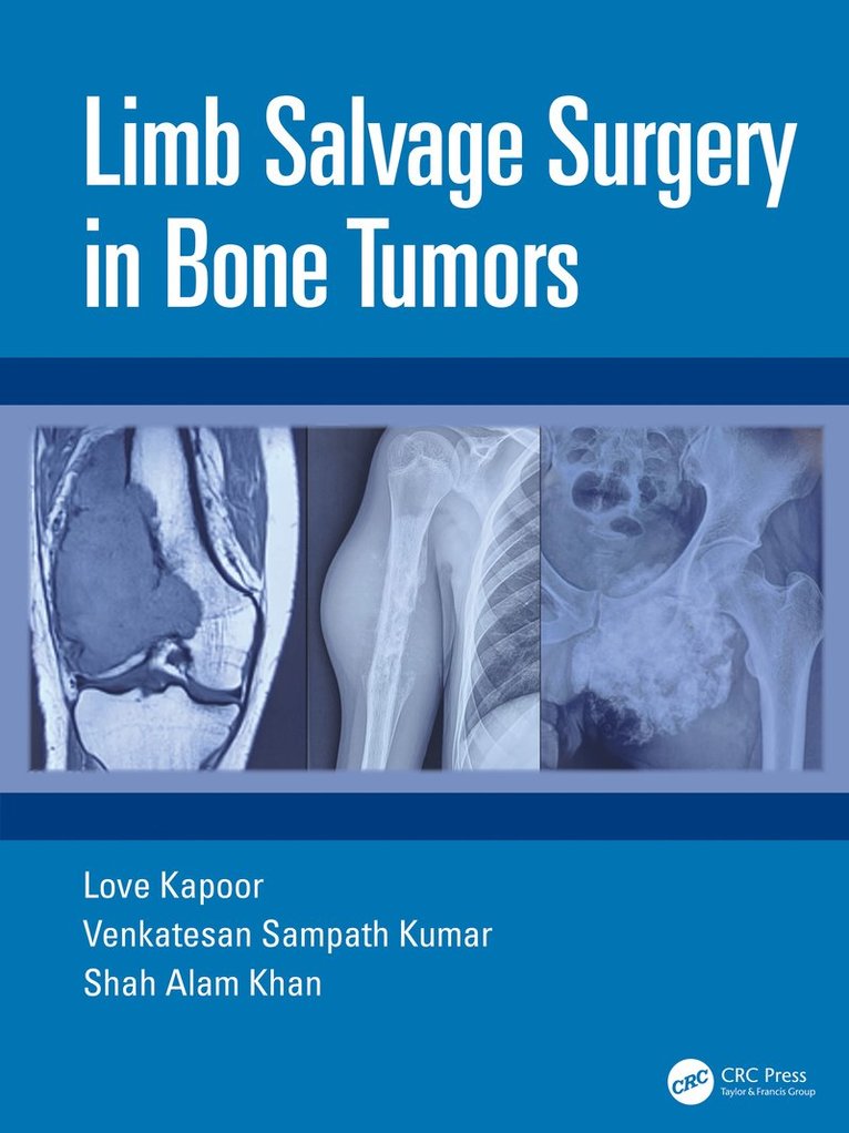 Limb Salvage Surgery in Bone Tumors