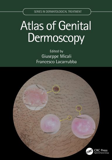 Giuseppe Micali, Francesco Lacarrubba - Atlas of Genital Dermoscopy, Inbunden