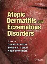 bokomslag Atopic Dermatitis and Eczematous Disorders