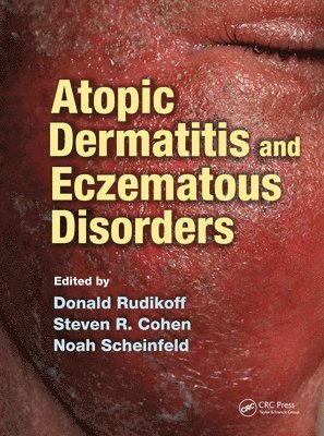 Donald Rudikoff, Steven Cohen, Noah Scheinfeld, NY) Rudikoff, Donald, MD (Chief of Derm., Bronx Lebanon Hospital: Associate Prof., AECM, Bronx, NY) Cohen, Steven R. (Prof and Chief, Div. of Derm., AECM, Bronx, USA) Scheinfeld, Noah (Weill Cornell Medical College, New York, New York, Steven R. Cohen - Atopic Dermatitis and Eczematous Disorders, Häftad