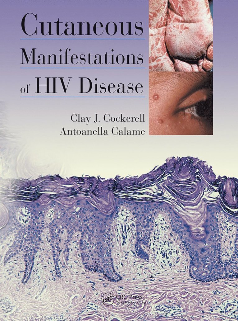 Clay Cockerell, Antoanella Calame - Cutaneous Manifestations of HIV Disease, Häftad