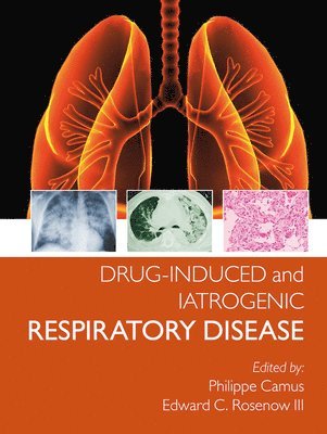 Drug-induced and Iatrogenic Respiratory Disease 1