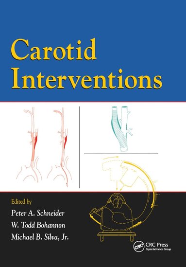 Peter Schneider, Todd Bohannon, Michael Silva - Carotid Interventions, Häftad