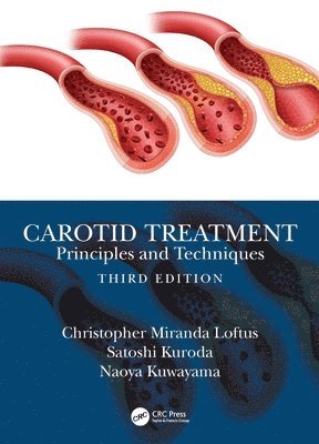 Carotid Treatment: Principles and Techniques 1