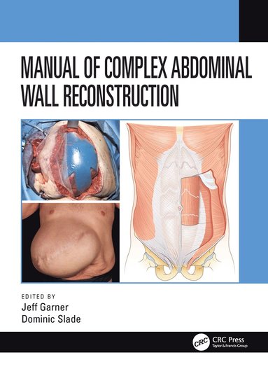 bokomslag Manual of Complex Abdominal Wall Reconstruction