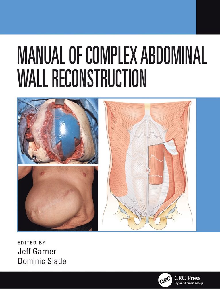 Manual of Complex Abdominal Wall Reconstruction 1