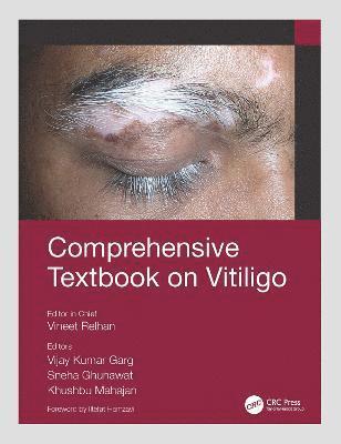 Comprehensive Textbook on Vitiligo 1