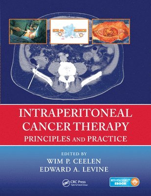 Intraperitoneal Cancer Therapy 1
