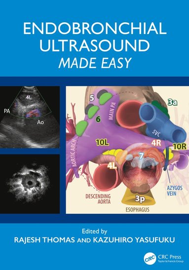 bokomslag Endobronchial Ultrasound Made Easy
