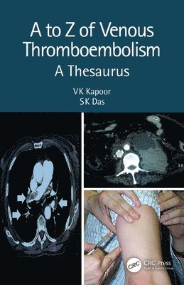 VK Kapoor, SK Das, India) Kapoor, VK (SGPGIMS, Lucknow, London) Das, SK (Brunel University, Vk Kapoor, Sk Das - to Z of Venous Thromboembolism, Inbunden