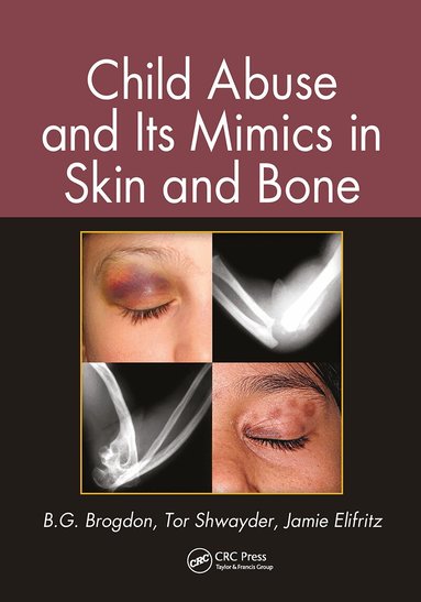 B. G. Brogdon, Tor Shwayder, Jamie Elifritz - Child Abuse and its Mimics in Skin and Bone, Häftad