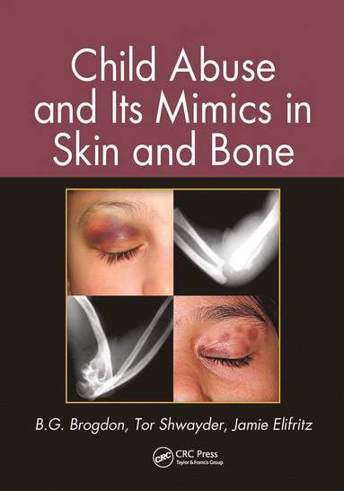 bokomslag Child Abuse and its Mimics in Skin and Bone