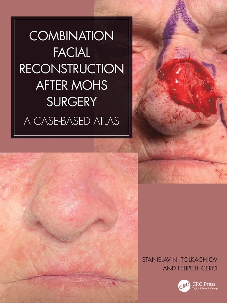 Stanislav N. Tolkachjov, Felipe B. Cerci, US) Tolkachjov, Stanislav N. (Mohs & Reconstructive Surgery Director, Epiphany Dermatology, TX, Brazil) Cerci, Felipe B. (Hospital de Clinicas da Univ Federal do Parana - Combination Facial Reconstruction after Mohs Surgery, Inbunden