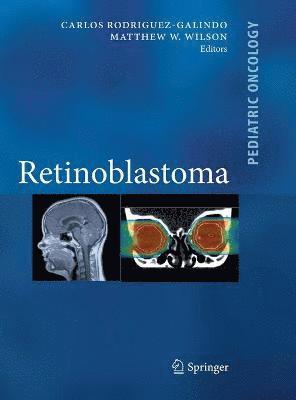 Retinoblastoma