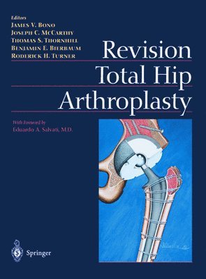 James V. Bono, R. H. Turner - Revision Total Hip Arthroplasty, Inbunden