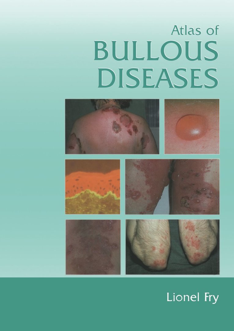 Atlas of Bullous Diseases 1