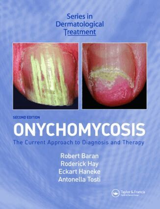 Robert Baran, Roderick Hay, Eckart Haneke, Antonella Tosti - Onychomycosis, Inbunden