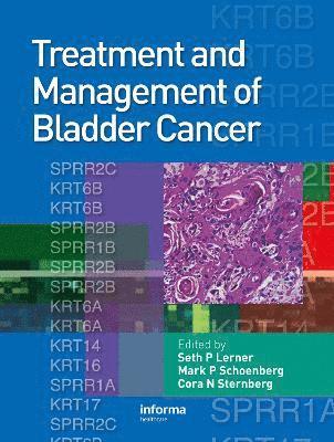 Treatment and Management of Bladder Cancer 1
