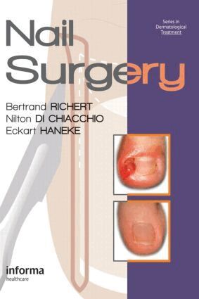 Bertrand Richert, Nilton Di Chiacchio, Eckart Haneke, Bertrand Richert, Nilton Di Chiacchio, Eckart Haneke - Nail Surgery, Inbunden