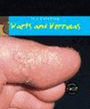 bokomslag Warts And Verrucas