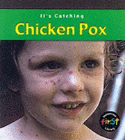 bokomslag Chickenpox