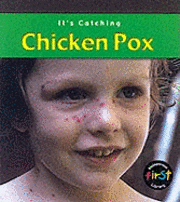 Chickenpox 1