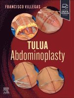 bokomslag TULUA Abdominoplasty