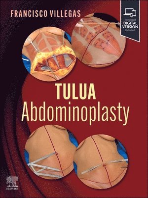 TULUA Abdominoplasty 1