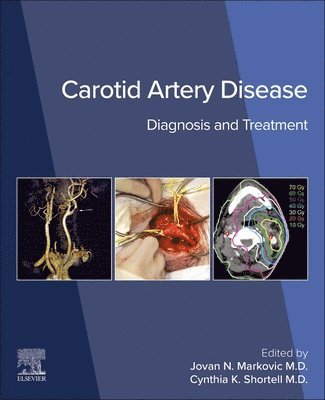 bokomslag Carotid Artery Disease