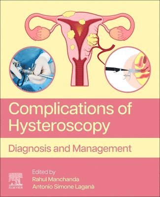 bokomslag Complications of Hysteroscopy