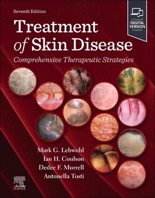 Mark Lebwohl, Ian H. Coulson, Dedee Murrell, Antonella Tosti - Treatment of Skin Disease, Inbunden