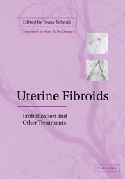 Uterine Fibroids 1