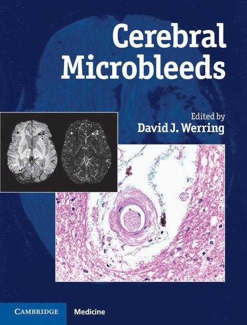 Cerebral Microbleeds 1