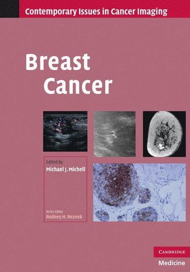 bokomslag Breast Cancer