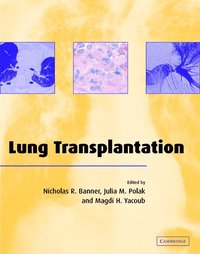 bokomslag Lung Transplantation