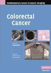 Colorectal Cancer