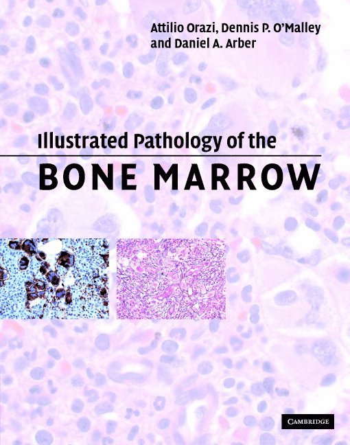 Illustrated Pathology of the Bone Marrow 1