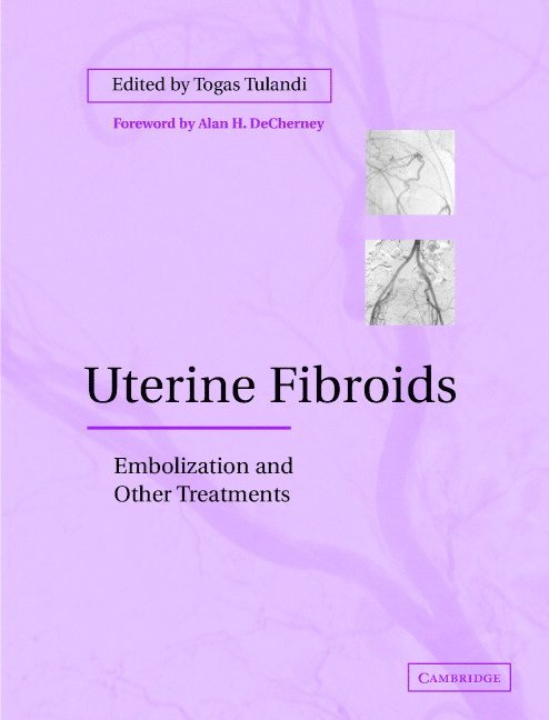 Uterine Fibroids 1