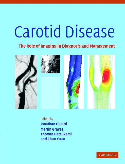 Carotid Disease 1