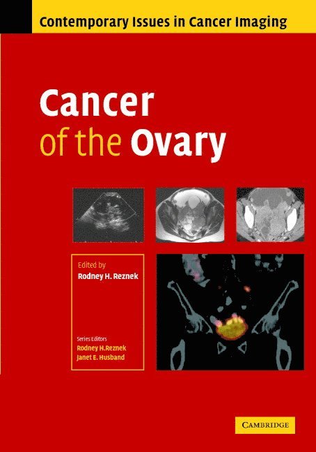 Cancer of the Ovary 1