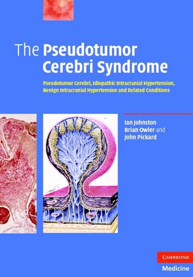Ian Johnston, Brian Owler, John Pickard - The Pseudotumor Cerebri Syndrome, Inbunden