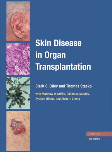 Clark C. Otley, Thomas Stasko - Skin Disease in Organ Transplantation, Inbunden