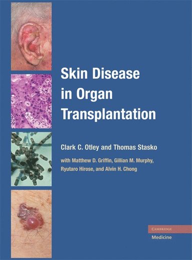bokomslag Skin Disease in Organ Transplantation