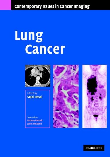 Sujal R. Desai - Lung Cancer, Inbunden