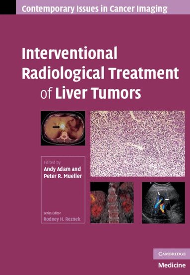 Andy Adam, Peter R. Mueller - Interventional Radiological Treatment of Liver Tumors, Inbunden