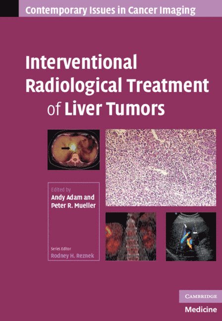 Andy Adam, Peter R. Mueller, Andy  (University of London) Adam - Interventional Radiological Treatment of Liver Tumors, Inbunden