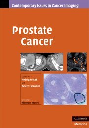 Hedvig Hricak, Peter Scardino - Prostate Cancer, Inbunden