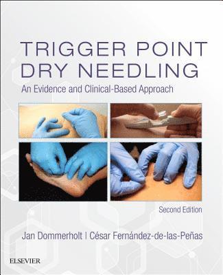 Trigger Point Dry Needling 1