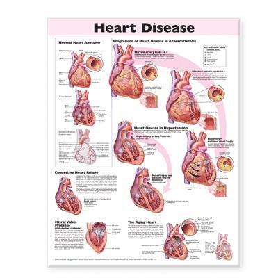 Heart Disease Anatomical Chart 1